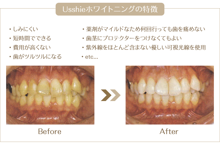 Usshieホワイトニングの特徴