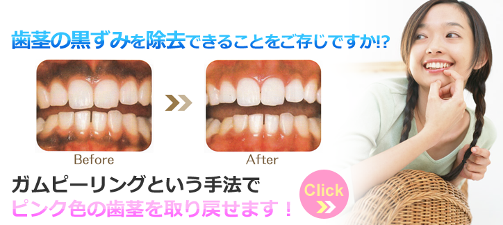 神戸市 ガムピーリング 歯茎の黒ずみ除去
