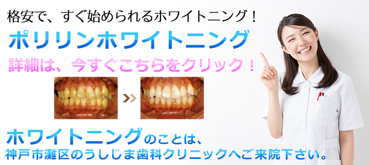 ホワイトニングは神戸市灘区の歯科医院（歯医者）うしじま歯科クリニックへ