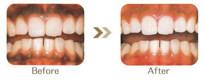 歯茎の黒ずみ除去ガムピーリング