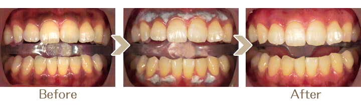 歯茎の黒ずみ除去ガムピーリング症例