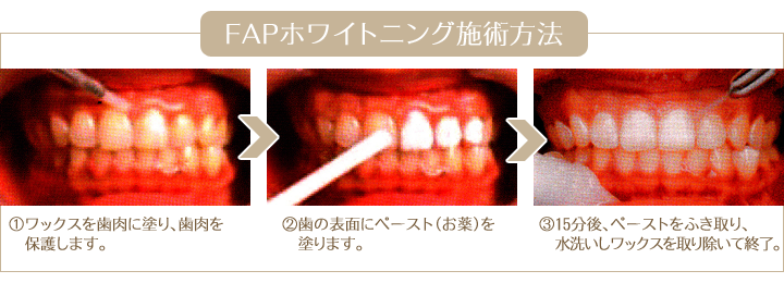 Fapホワイトニングは神戸市灘区の歯科医院 歯医者 うしじま歯科クリニックへ Fapホワイトニング