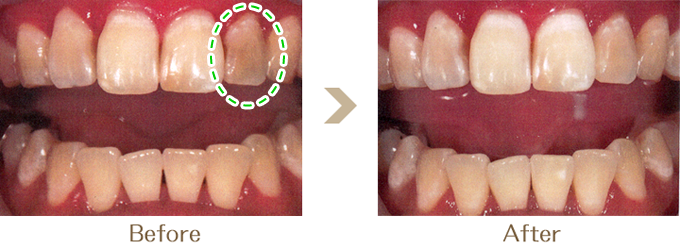 症例１：失活歯（オパール３回）+usshieホワイトニング１回