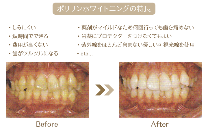 オフィスホワイトニングは神戸市灘区の歯科医院 歯医者 うしじま歯科クリニックへ ポリリンホワイトニング