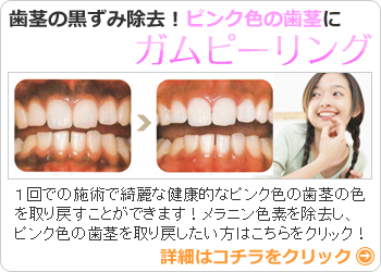 神戸　ガムピーリング　歯茎の黒ずみ除去