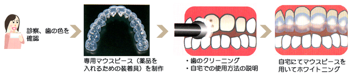ホームホワイトニングの手順